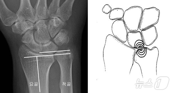 좌측의 그림처럼 손목에서 척골의 길이가 요골보다 긴 경우, 우측의 그림처럼 척골과 수근골 사이에 충돌이 일어나는 상태를 ‘척골충돌증후군’이라고 한다&#40;중앙대학교병원 제공&#41;