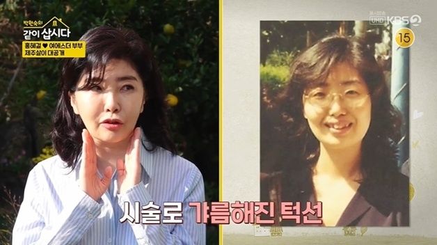 '홍혜걸♥' 여에스더 "교정 후 광대뼈 들어가, 약간의 보톡스" 성형설 부인