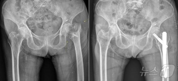 대퇴부 골절&#40;왼쪽부터&#41;과 수술 뒤 사진&#40;센텀종합병원 제공&#41;