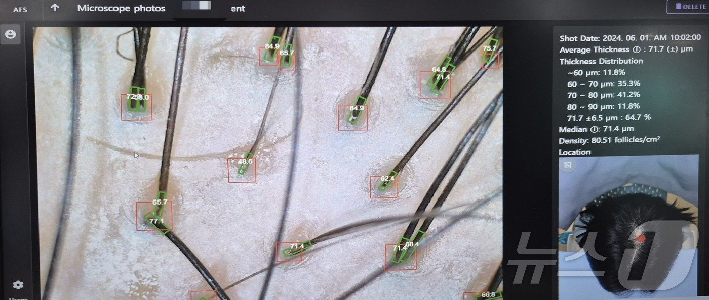 아프스&#40;AFS&#41;의 AI 기반 정밀 탈모 진단 장치 &#39;AFS 3D&#39;로 촬영한 모발 분석 화면.2025.1.8/뉴스1 최동현 기자