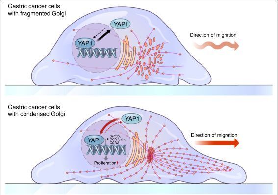 세포 '우체국'이 암을 키운다…골지체 응축, 위암 악성도 높이는 핵심 기전