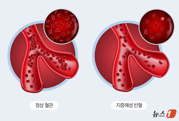 [100세건강]지중해·중동서는 흔하지만 한국인에게 희귀한 '이 질환'