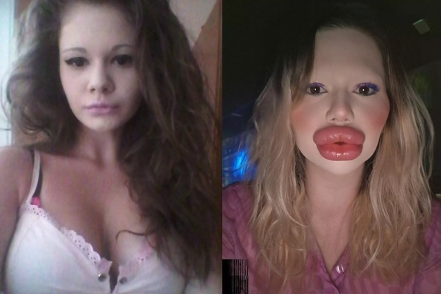 "입술 필러에 3800만원 쓴 여성…의사도 '흉하다' 시술 거부"