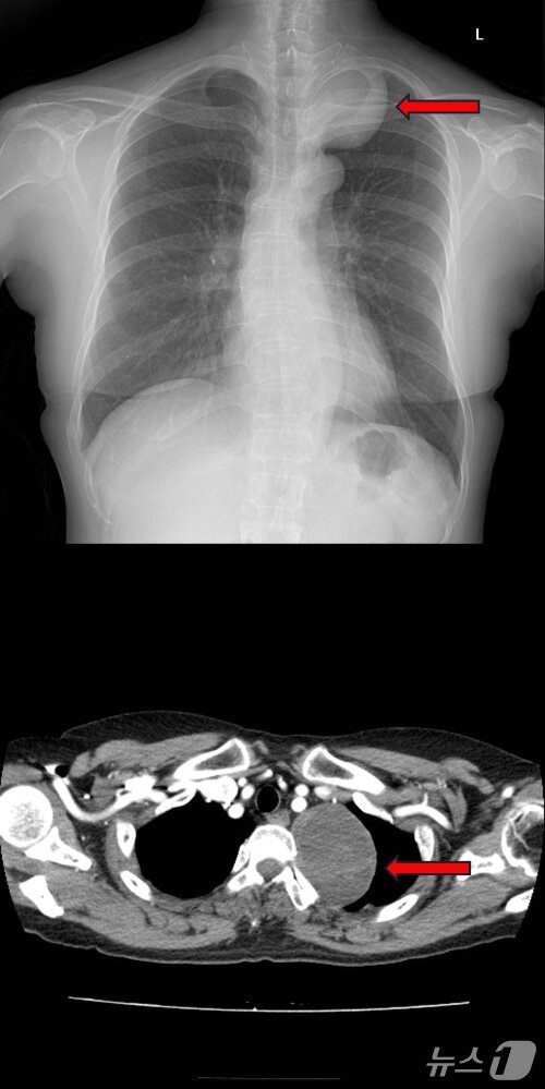 본문 이미지 - 종격동 종양 환자의 흉부 X선사진(위), 종격동 종양 환자의 흉부 CT사진(아래).(고려대학교 안산병원 제공)
