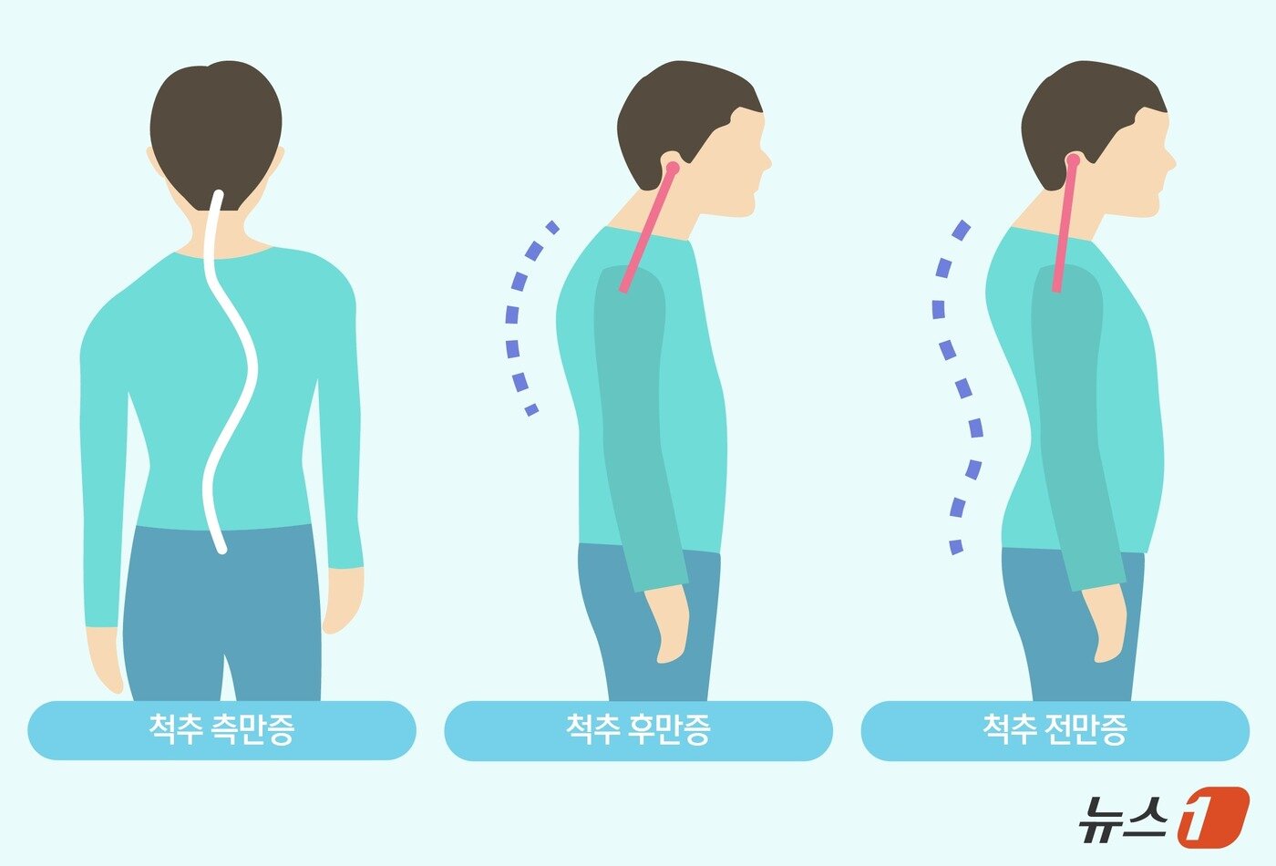 본문 이미지 - 척추변형은 단순히 척추가 평면적으로 휘는 질환이 아니라 척추 마디가 서로 회전하며 꽈배기처럼 비틀어지는 3차원적 변형으로 나타난다. 측면에서 등이 굽는 형태는 후만증, 정면에서 좌우로 휘는 형태는 측만증 등으로 구분된다. 변형이 심해지면 심폐기능 저하로 이어질 수 있다. ⓒ 뉴스1 양혜림 디자이너