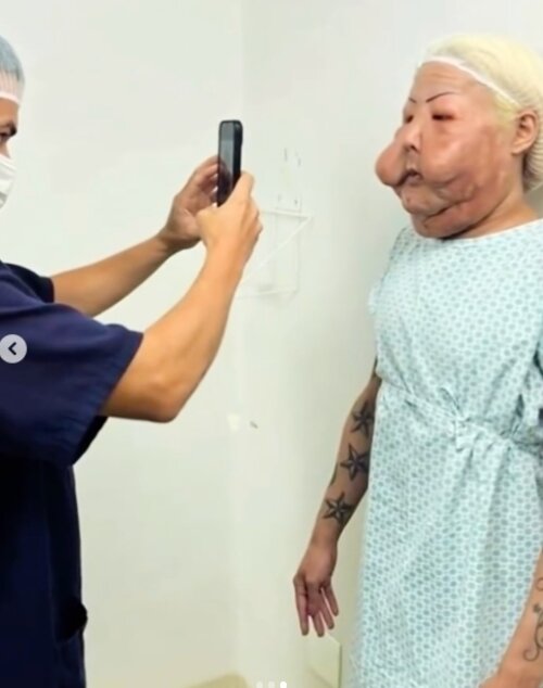 본문 이미지 - 불법 시술로 변형된 얼굴을 재건 수술 받기 위해 준비 중인 줄리아나 올리베이라. 출처='인콰이어러'