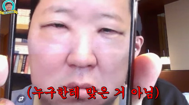 정형돈, 성형 후 충격적 부기 공개…"일주일 동안 못나가"