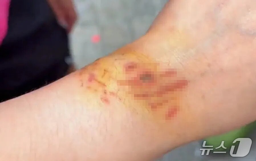 본문 이미지 - A 씨 손목에 난 상처. (신추데일리 갈무리)