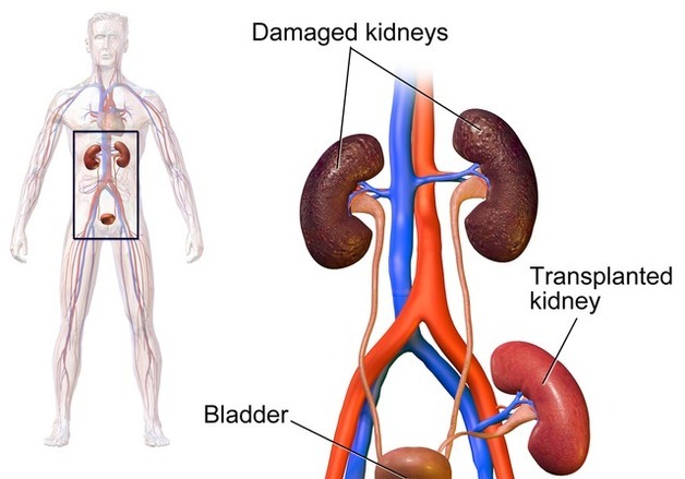 의학사의 기적, 최초의 신장 이식 성공 [김정한의 역사&오늘]
