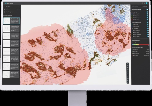 담도암 HER2 진단에 AI 활용 가능성 확인…전문의와 83.5% 일치
