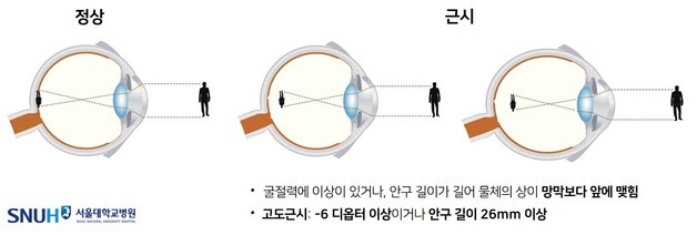 [100세건강] '고도 근시→시력 손상' 이어져…정기 안과검진 필수
