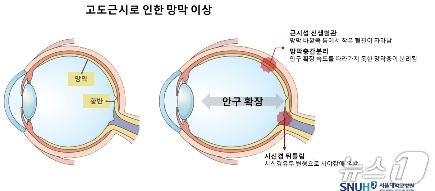 본문 이미지 - 고도 근시로 인한 망막 이상.(서울대병원 제공)