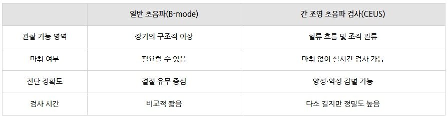 본문 이미지 - 일반 초음파와 간 조영 초음파 검사 비교 표(병원 제공) ⓒ 뉴스1