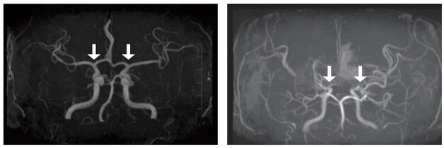 소아 모야모야병 유병률 늘었지만 치명적 합병증 40% 줄어