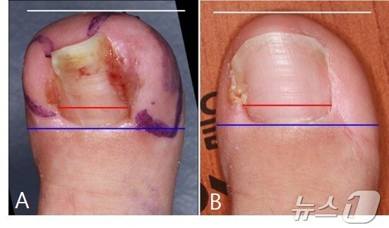 본문 이미지 - 연부조직 절제 수술 전(A)과 수술 후 (B). (세브란스 제공) 2025.3.6/뉴스1