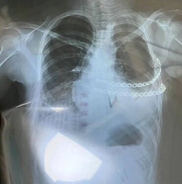 본문 이미지 - 쉬안이 인공 가슴을 장착하고 찍은 X-Ray.