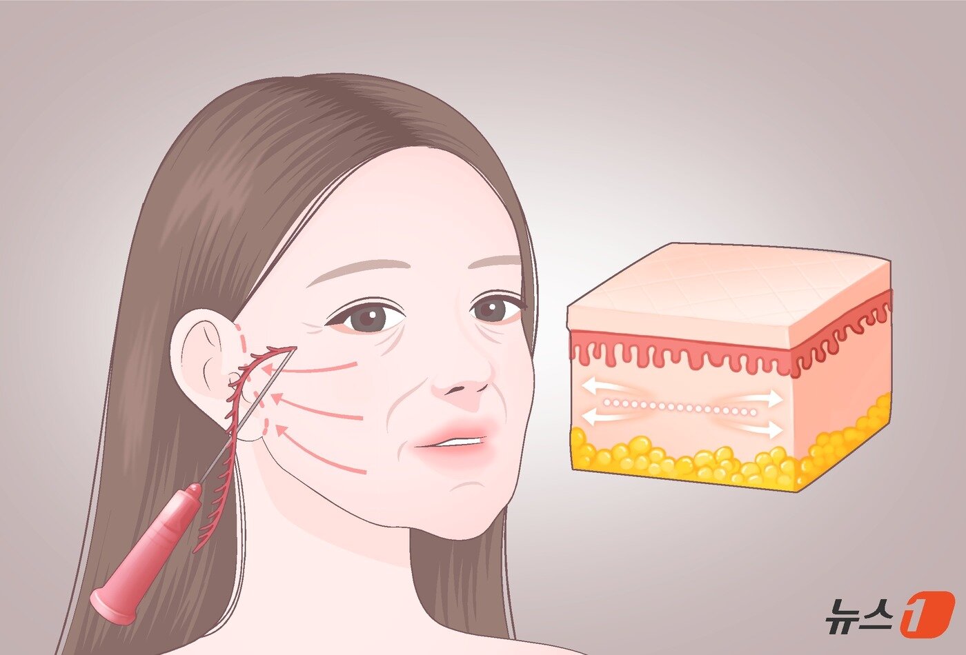 본문 이미지 - '복합 시술'은 에너지 기술로 구조를 정비하고 스킨부스터로 수분 환경을 채우는 원리라고 할 수 있다. 에너지 디바이스 기반 시술과 히알루론산 제제는 서로 다른 층위에서 피부 상태를 보완함으로써 보다 자연스럽고 조화로운 결과를 기대할 수 있다. ⓒ 뉴스1 윤주희 디자이너