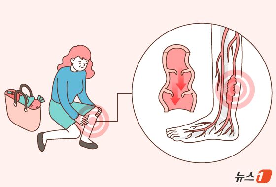 [100세건강] 퉁퉁 붓고 쥐 나는 '이 병'…"직립 보행 필연적 결과"