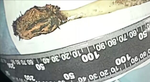 12살때 삼킨 칫솔 52년만에 제거한 남성…"엄마한테 혼날까 봐 말 못 했다"
