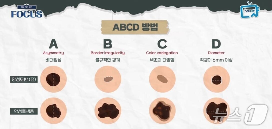본문 이미지 - ABCD 자가진단법&#40;서울대병원 제공&#41;