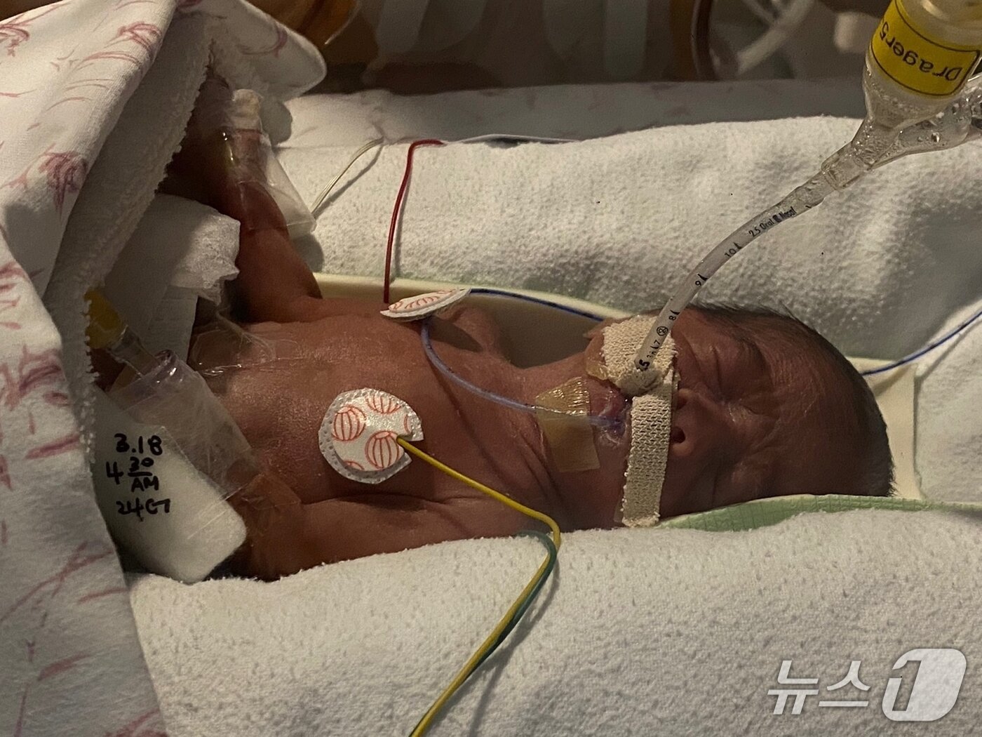 본문 이미지 - 쩐푹안 군이 인큐베이터 안에서 치료를 받고 있다.(강릉아산병원 제공, 재판매 및 DB 금지) 2025.7.24/뉴스1