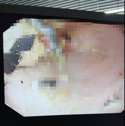 본문 이미지 - 내시경을 통해 확인한 태블릿PC 조각들(온동물의료센터 제공) ⓒ 뉴스1