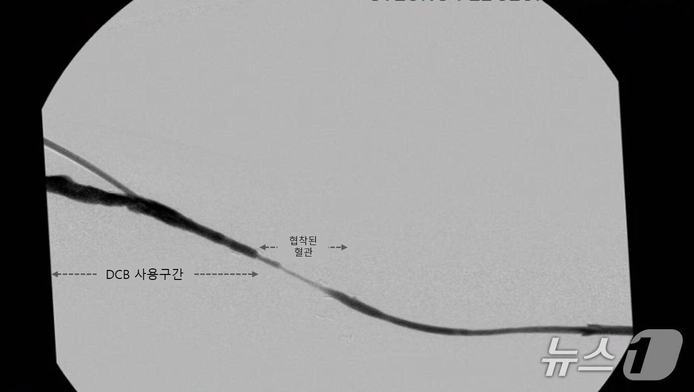 본문 이미지 - 약물 방출 풍선 카테터(인팩트 DCB) 시술을 받은 지 3개월이 경과한 후 혈관의 모습. DCB 시술을 받은 부위만 혈관이 양호한 상태를 보였다. (생명선의원 제공)