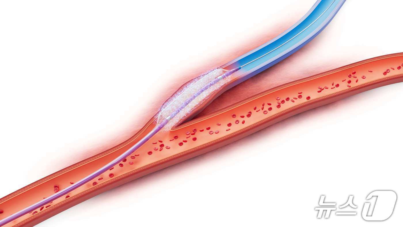본문 이미지 - 메드트로닉의 약물방출 풍선 카테터/뉴스1