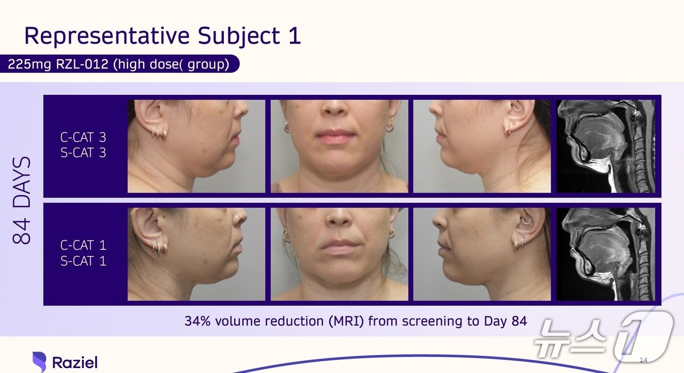 본문 이미지 - 임상 2b상 결과 RZL-012 고용량 투여군은 위약군보다 최대 34% 지방 감소를 확인했을뿐더러, 기존 데옥시콜레이트&#40;DCA&#41; 성분의 주사&#40;4~6회 투여&#41; 대비 단일 시술만으로 더욱 우월한 효과를 얻을 수 있었다.&#40;라지엘 테라퓨틱스 제공&#41;
