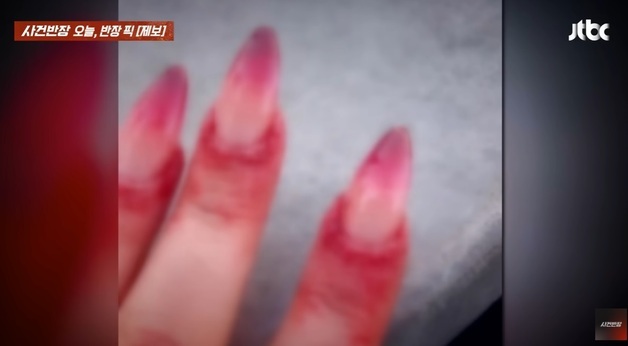 "손톱 시술 후 손가락 퉁퉁, 40만원 달라"…진단서엔 '위십이지장염' 황당