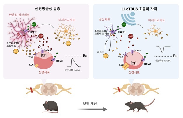 IBS, 뇌파 모사 초음파로 만성 신경병증성 통증 장기적 완화 성공