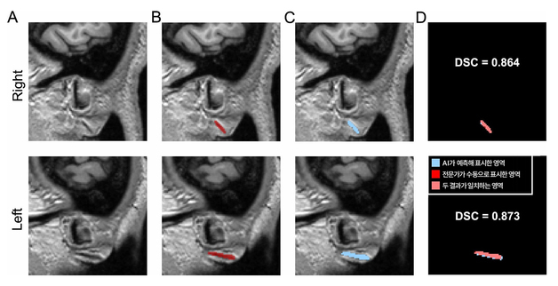 귓불 사선형 주름, 단순 노화 현상 아닌 뇌소혈관 손상과도 연관