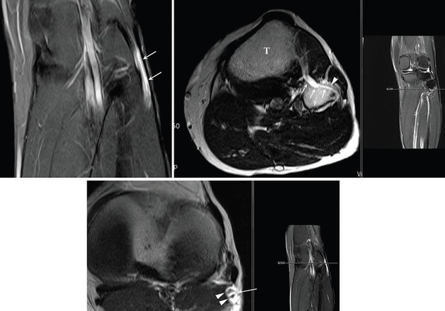손병철 서울성모병원 교수, 희귀 난치성 양성종양 발생 기전 확인