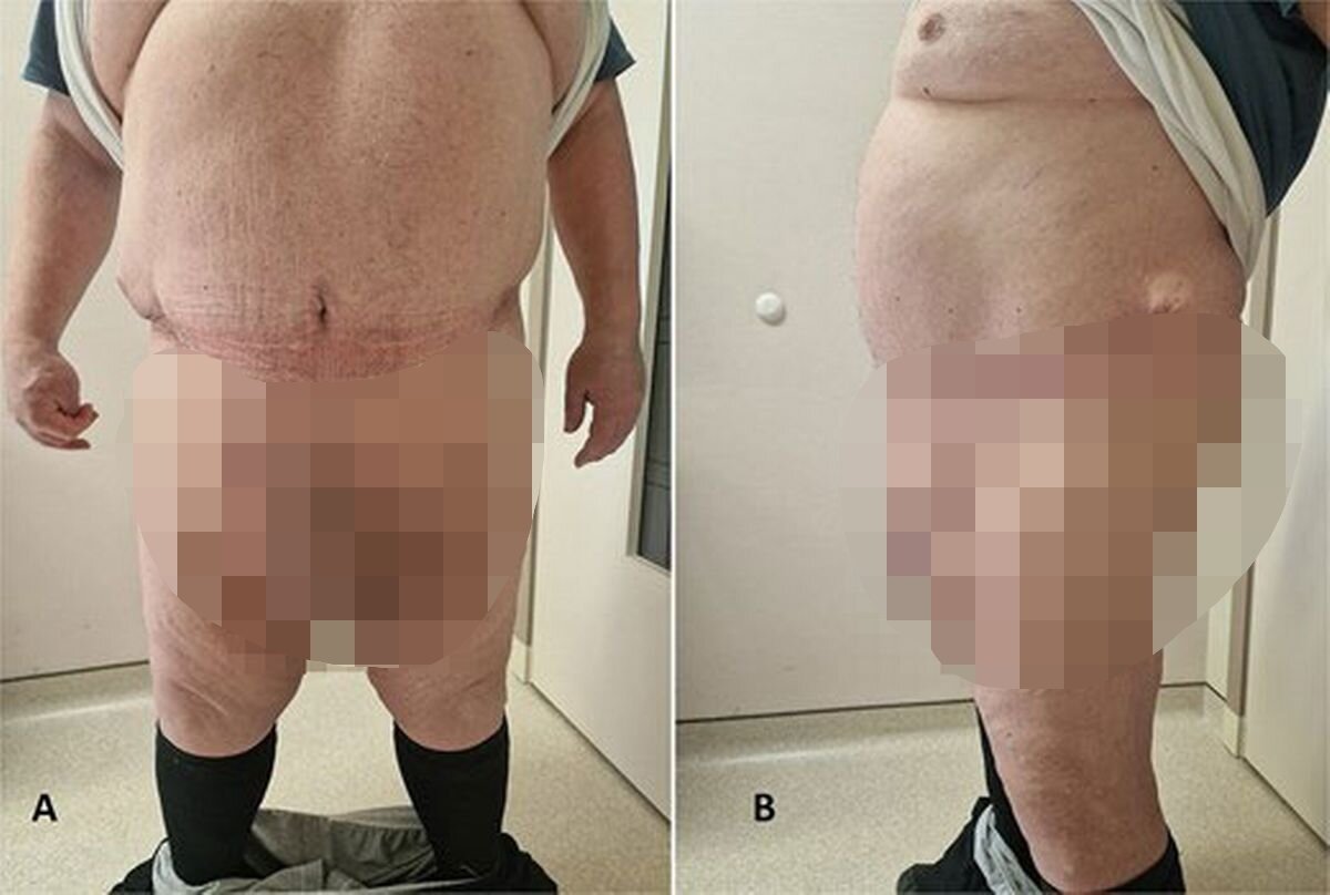 본문 이미지 - 수술 후 복부 상태. (데일리스타)