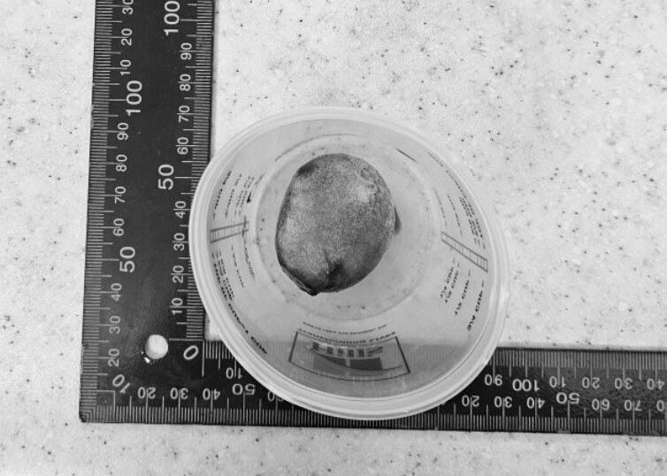 본문 이미지 - 방광에서 제거한 결석(광주 스카이동물메디컬센터 제공) ⓒ 뉴스1