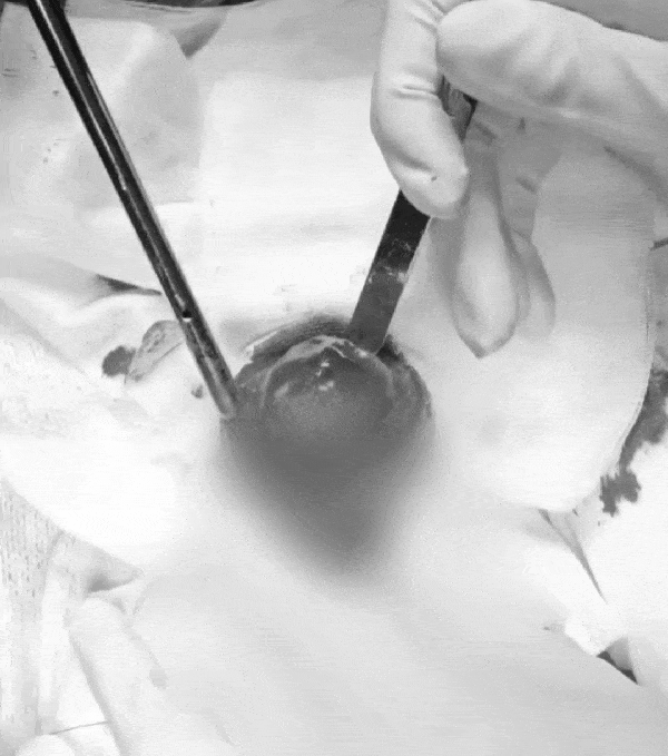 본문 이미지 - 방광 결석 수술 제거 장면(광주 스카이동물메디컬센터 제공) ⓒ 뉴스1