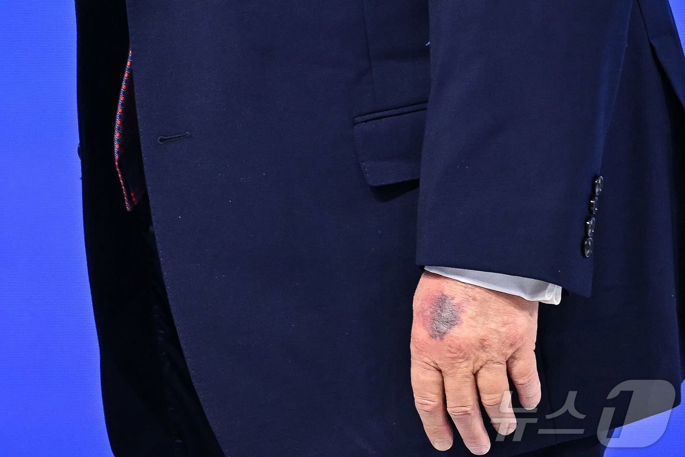 (다보스 AFP=뉴스1) 윤다정 기자 = 22일(현지시간) 스위스 다보스에서 열린 세계경제포럼(WEF) 연차총회(다보스포럼)에 참석한 도널드 트럼프 미국 대통령의 왼손 손등에 멍이 …