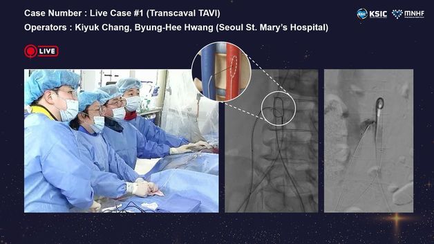혈관 막혀 판막 시술 어려운 환자, 정맥 통하는 새 치료 길 열렸다