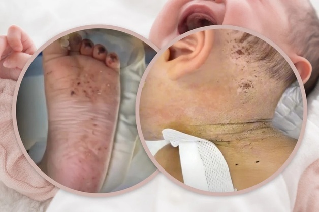 '생후 10개월' 아기, 600바늘 찔려 병원행…"엄마가 민간요법으로 채혈"