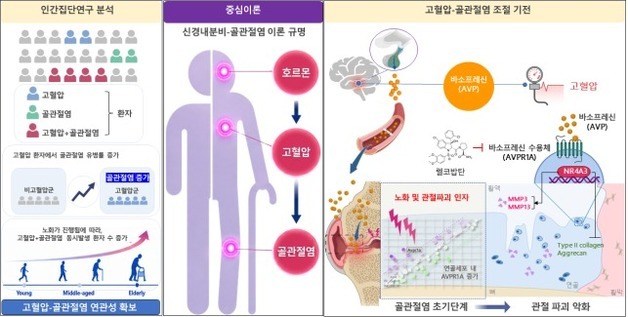 혈압 높으면 왜 관절염도 심해질까…'뇌-관절' 연결고리 찾았다