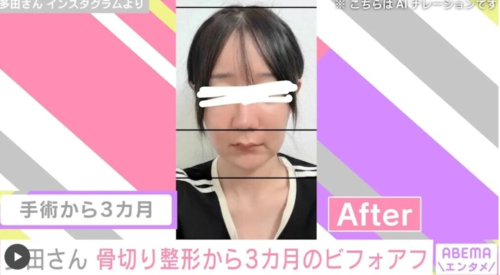본문 이미지 - 일본 방송인 다다 씨가 한국에서 양악, 안면윤곽 수술 3개월 후의 모습을 공개했다. /사진=ABEMA 방송 화면 갈무리