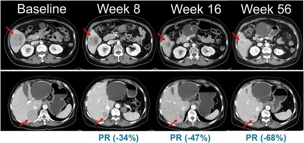 한미약품, 흑색종 신약 '벨바라페닙' 2상 환자 투약 개시