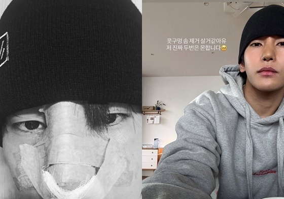 육준서, 부러진 코 재건 성공…"두 번은 못해" [N샷]