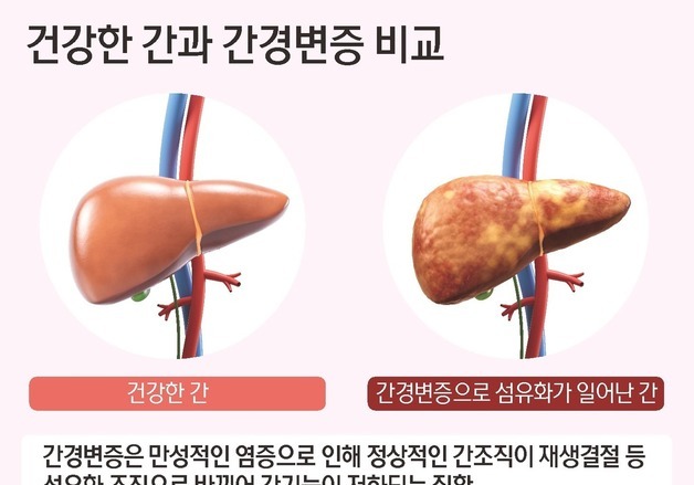 [100세건강] "70% 망가져도 모른다"…간경변증이 보내는 경고