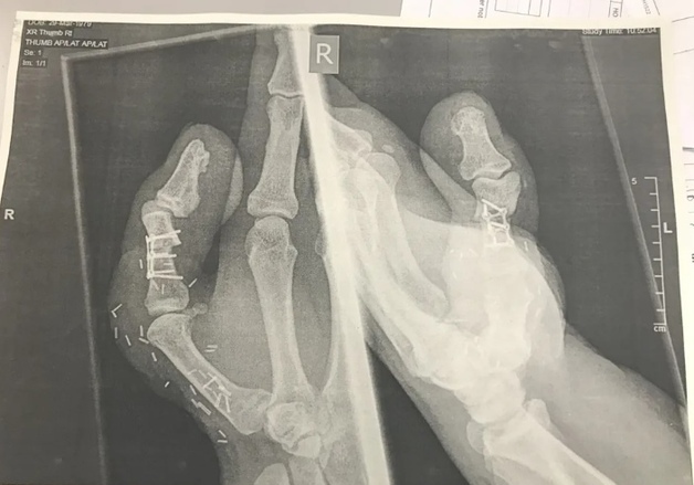 엄지손가락 절단당하자 발가락 붙인 구두 수선공…"일 계속하기 위해"