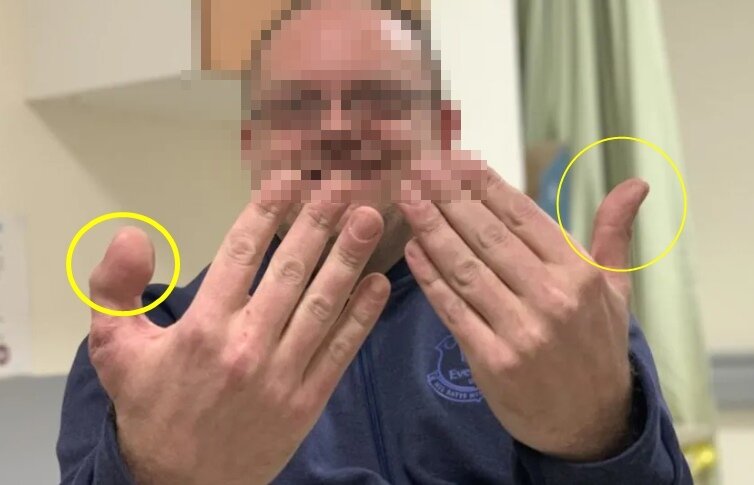 본문 이미지 - 엄지발가락 성공적으로 이식받은 구두수선공 데이비드리. 출처=BBC