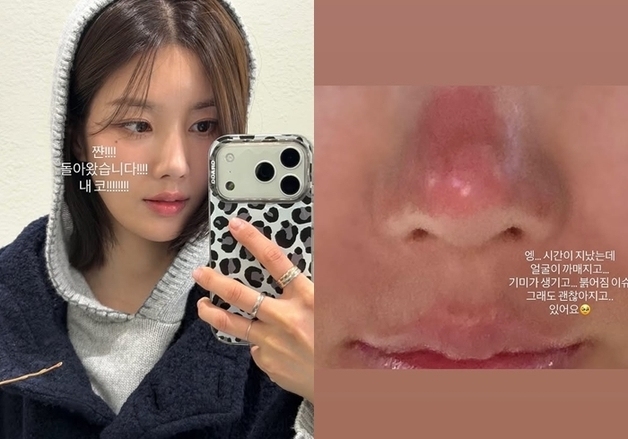 '킬리만자로 등반' 권은비, 코·입술에 2도 화상 "놀라셨죠"