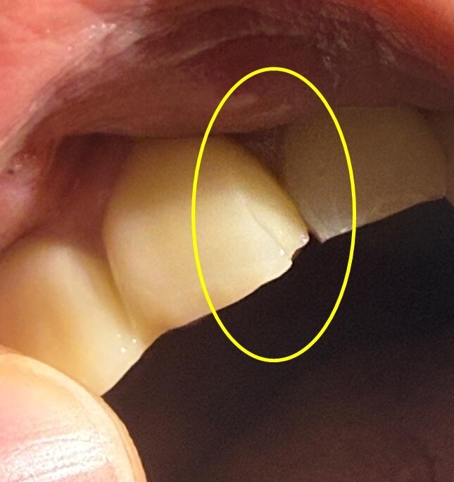 본문 이미지 - 유명 프랜차이즈 햄버거 패티에서 금속조각이 나와 소비자의 앞니가 깨지는 사고가 발생했다. 출처=보배드림