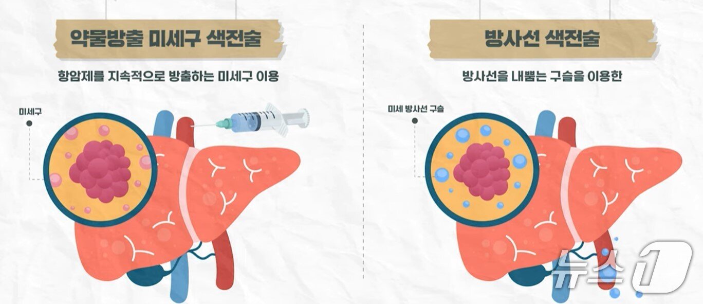 본문 이미지 - 최신 간암 색전술.(서울대병원 제공)