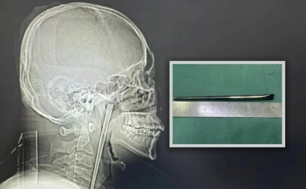 12㎝ 젓가락이 목에 8년째 박혀있었다…'알코올 중독' 남성 "숙취인 줄"